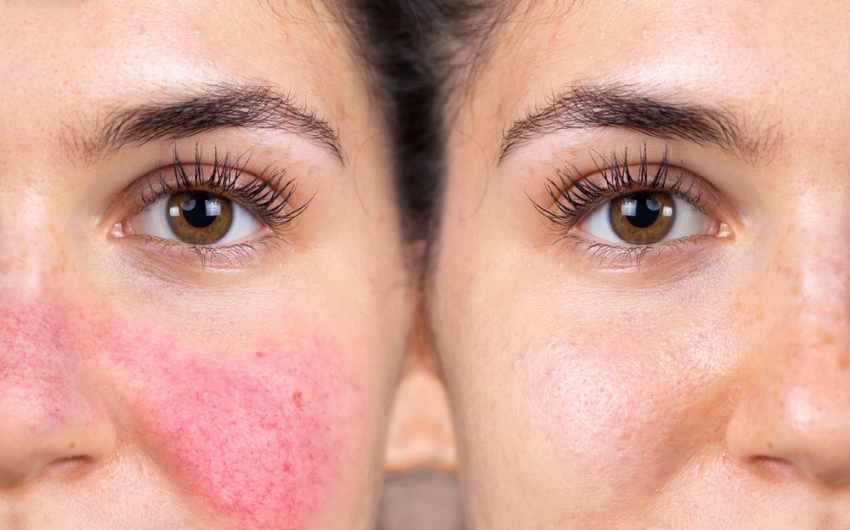 Migliore crema viso per rosacea: ecco quale scegliere