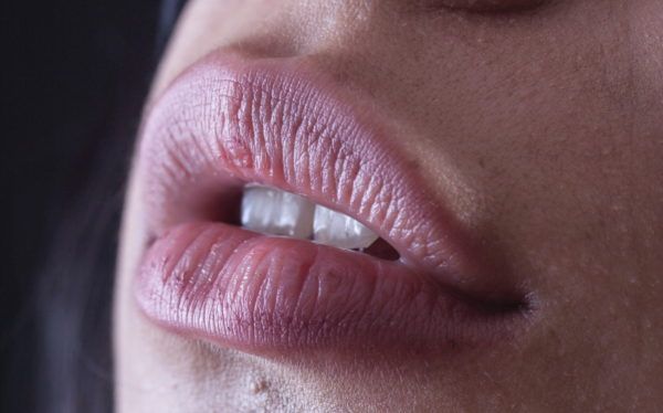 acido ialuronico per labbra